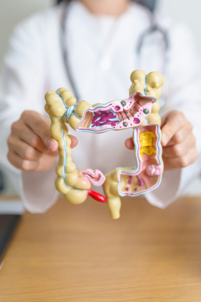 Doctor with human Colon anatomy model. Colonic disease